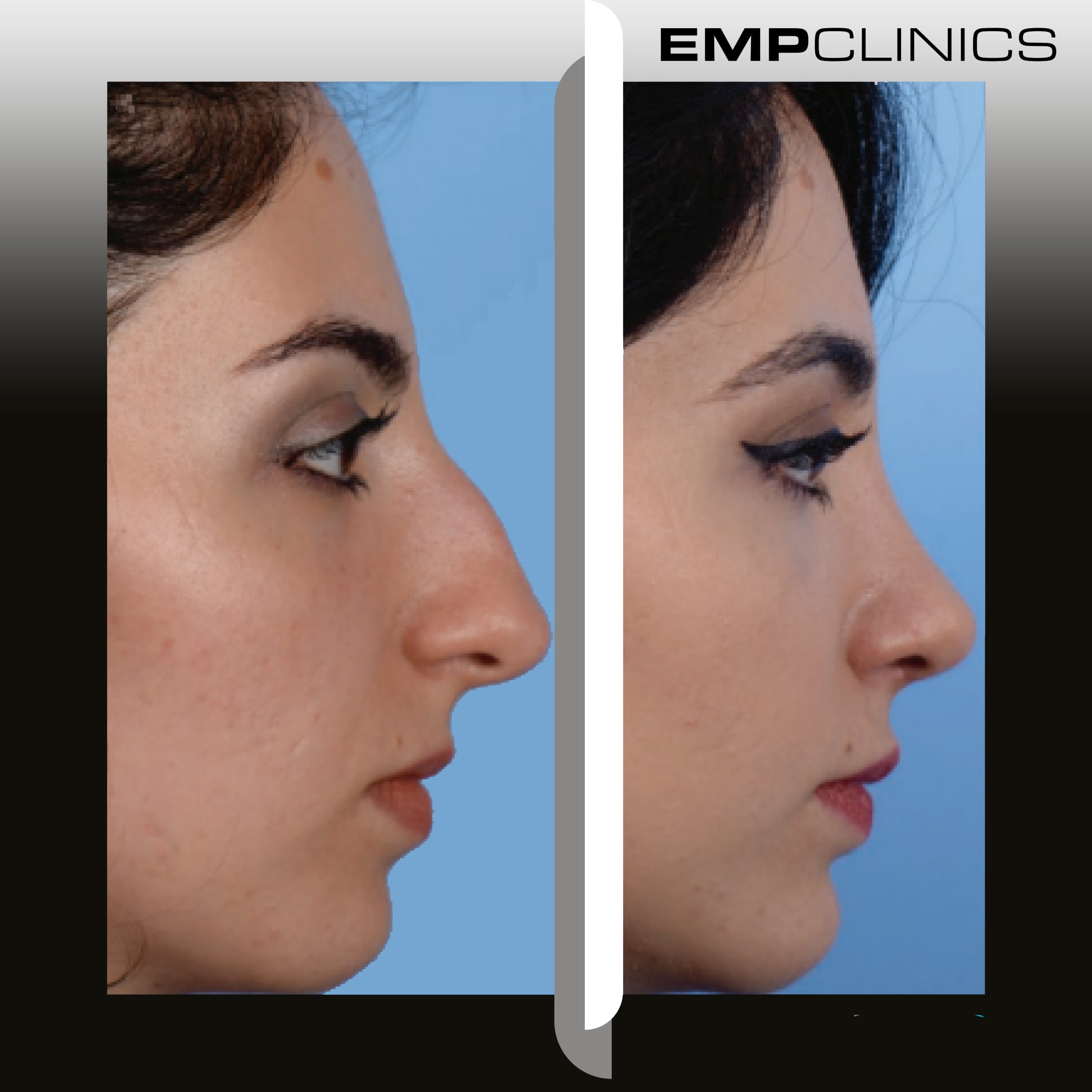 empclinics before after rhinoplasty-1